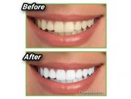 Přírodní uhlí pro bělení zubů – Miracle Teeth